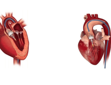 TAVI – Definition and Application